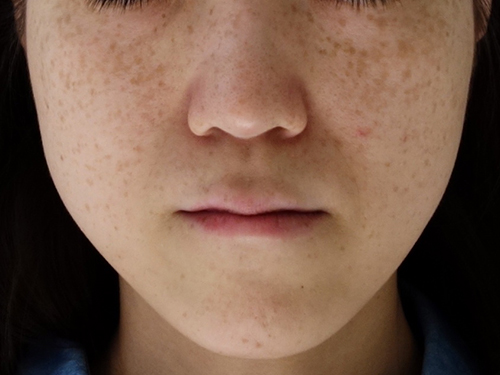 尋常性白斑の脱色療法しむら皮膚科クリニック