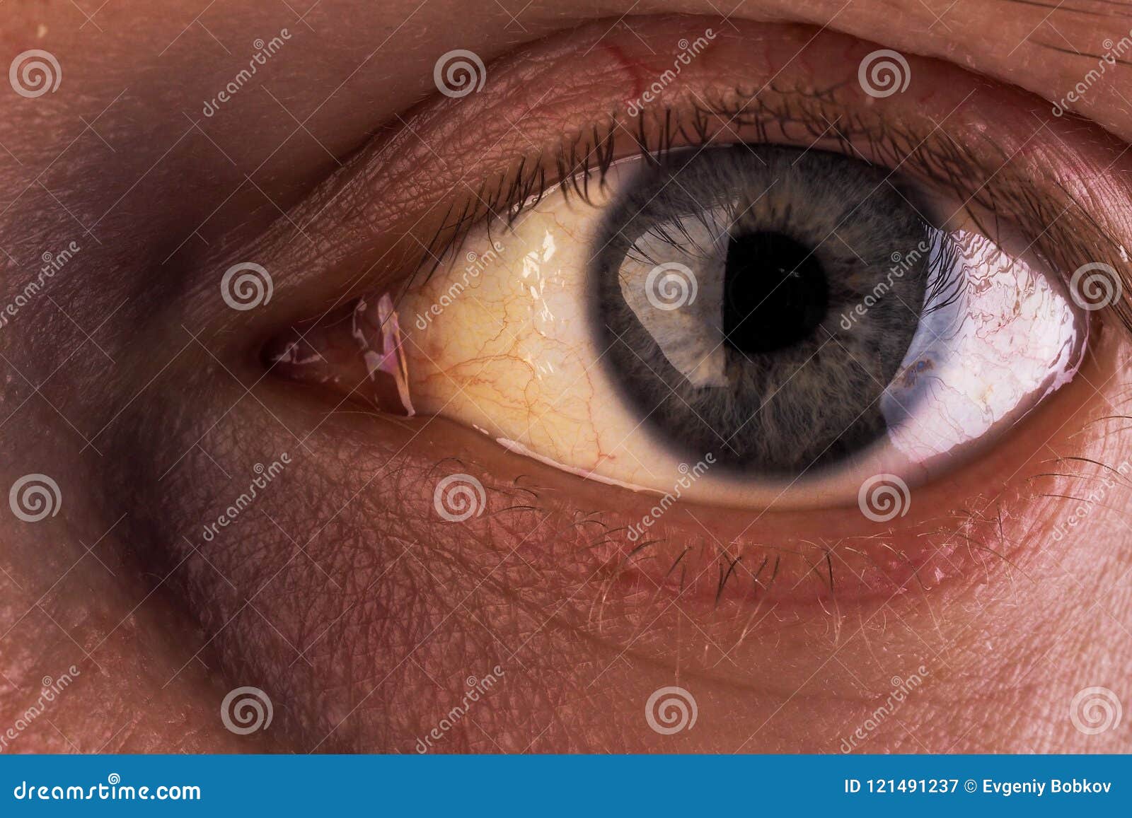 阻塞性黄疸，眼睛严重发黄变色。照片-正版商用图片14xpno-摄图新视界