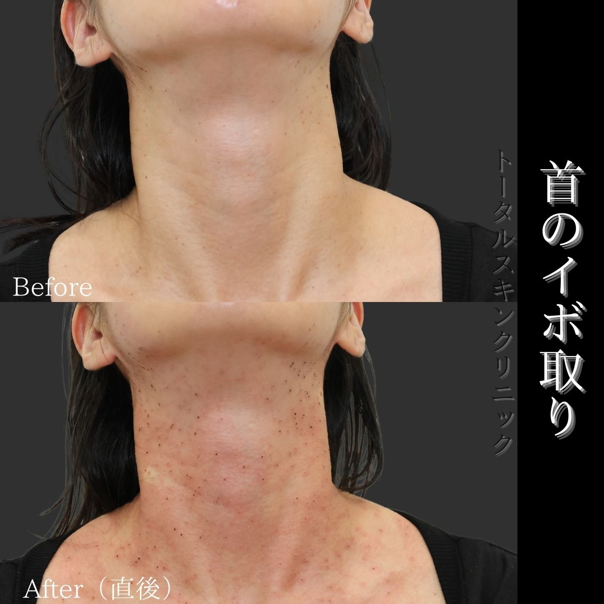 唇のシミ取り放題！医療レーザーの経過、全て見せます＠BAILA