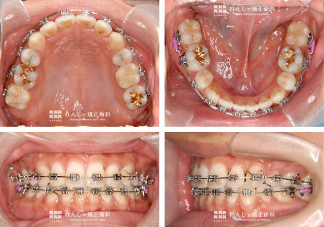 ワイヤー矯正 経過 - 名古屋の矯正歯科・歯列矯正・診療 名駅アール歯科・矯正歯科