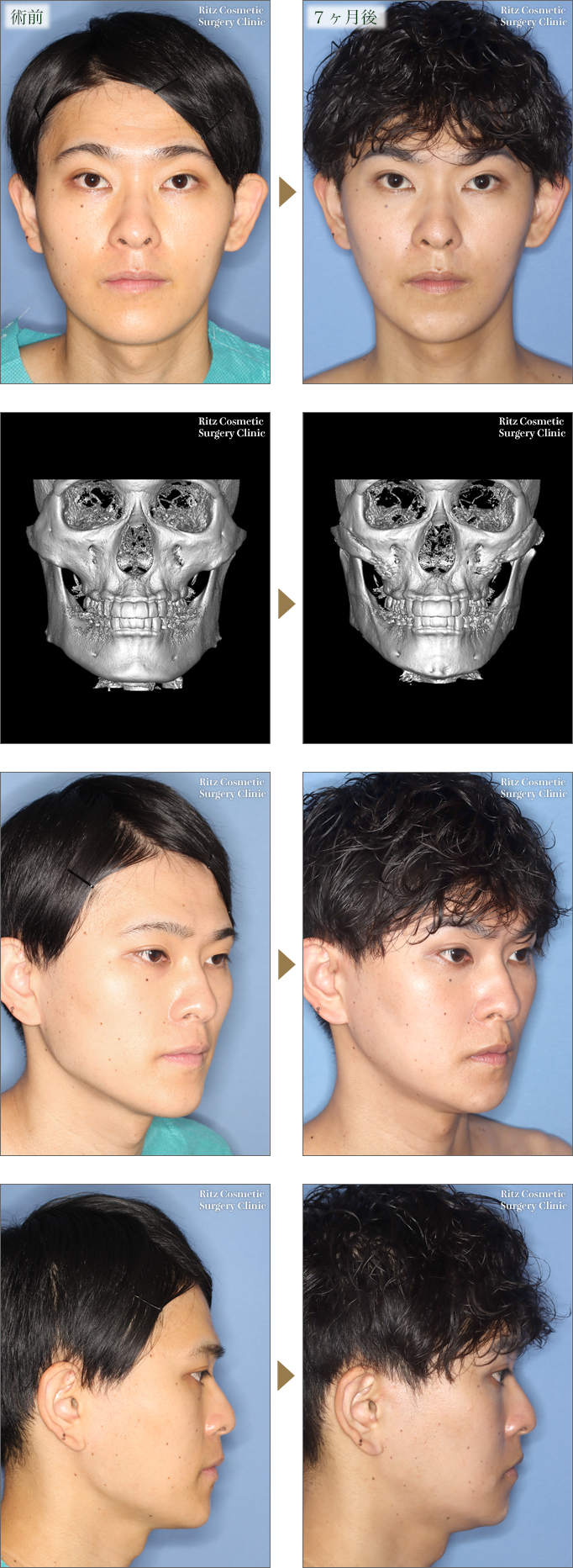 男性必見・顔をシュッとさせる・小顔になる方法輪郭形成・小顔整形 コラム池袋の小顔整形・顔痩せ・輪郭整形みずほクリニック