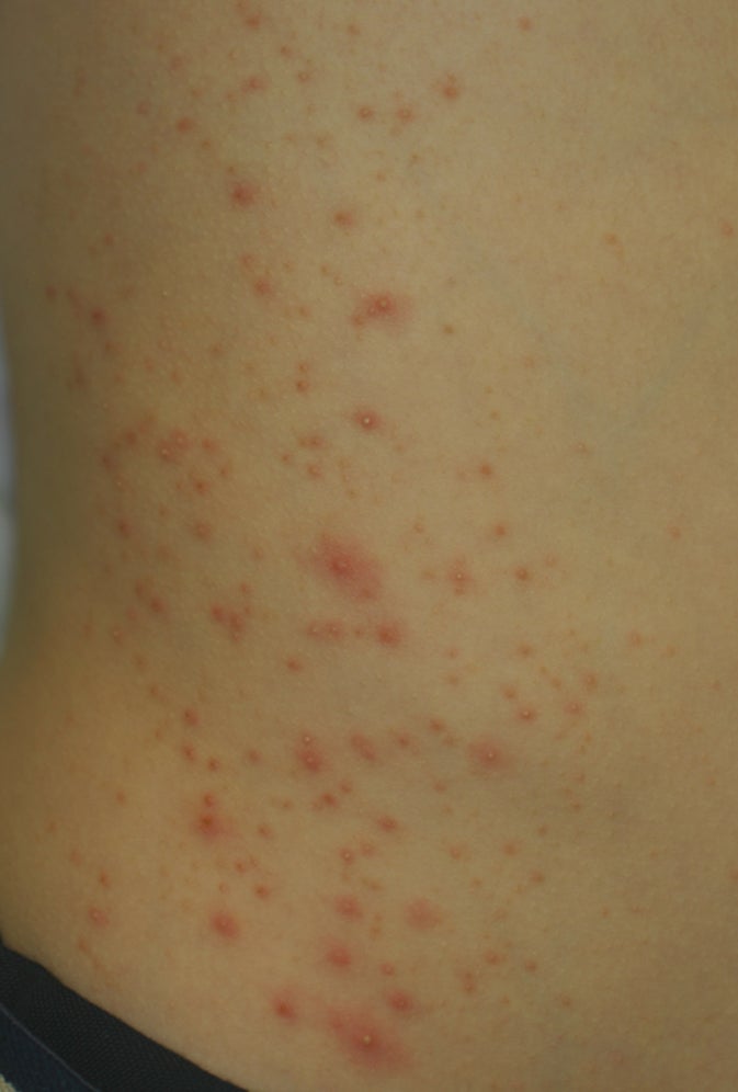 あせも 汗疹 とは大量の発汗により汗の排出が不十分になる発疹あさ美皮フ科亀戸駅前