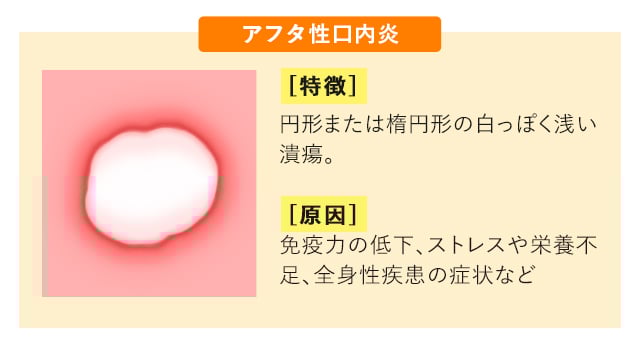 口内炎の予防・改善で生活の質を向上大正健康ナビ大正製薬