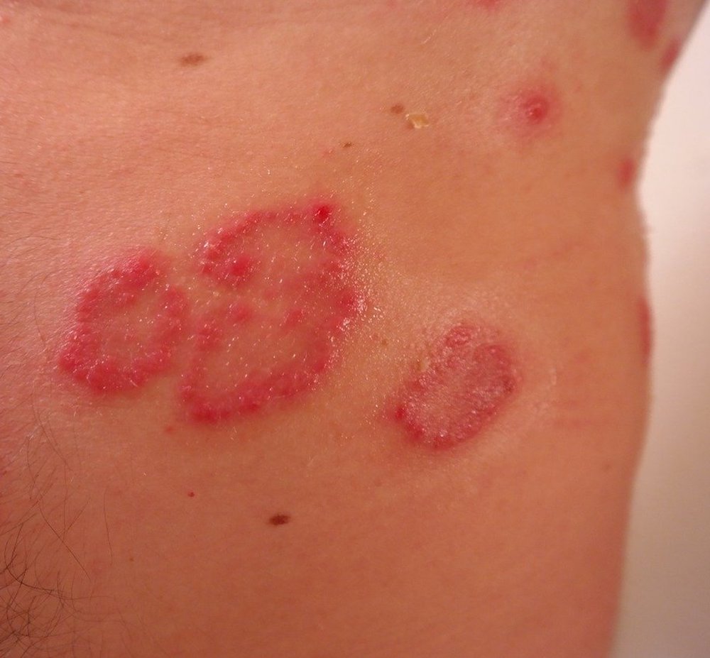 堺市中区で乾癬の皮膚科ひふみるクリニック