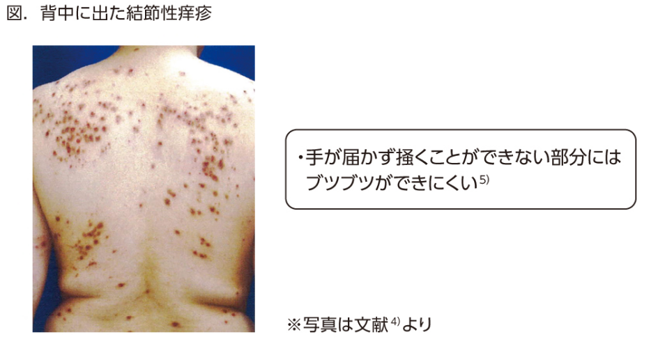 アトピー性皮膚炎とは？原因・症状や最新の治療法 注射薬 を医師が解説！ - オンライン診療ならウチカラクリニック