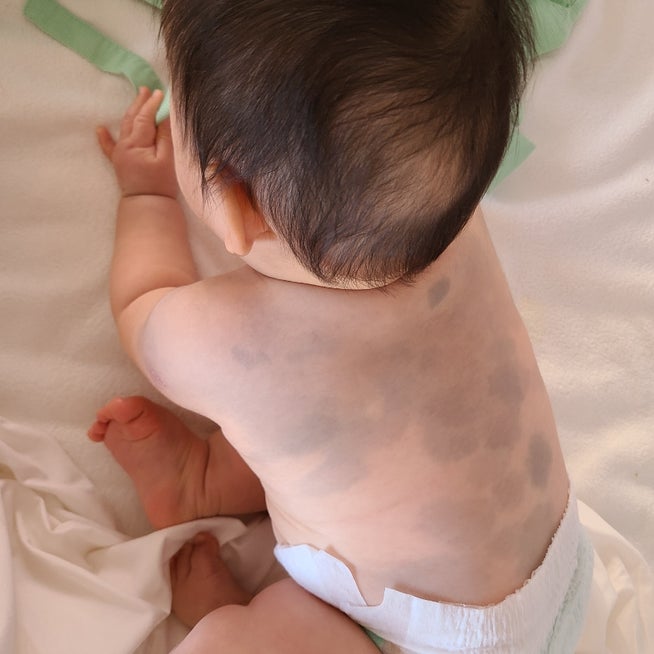 異所性蒙古斑のレーザー治療はお早めに！松島皮膚科医院千葉 四街道の皮膚科・美容皮膚科の専門医