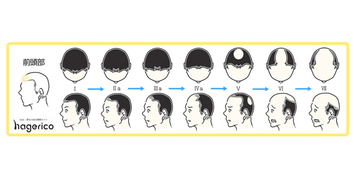 20代で頭頂部が薄いのはなぜ？薄毛のチェック方法や原因・対策を徹底解説スカルプD コラムスカルプD公式サイトアンファ