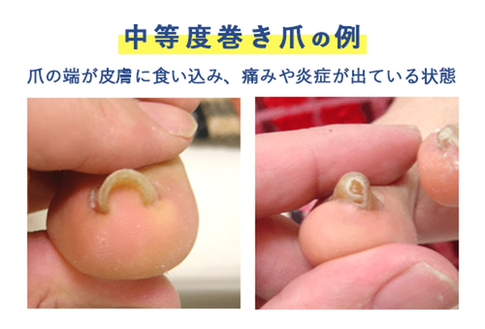 自宅で陥入爪・巻爪矯正 乾燥で巻爪が悪化しやすい季節。正しい巻き爪の切り方・保湿等のホームケアを丁寧にご紹介。ENG SUB - YouTube