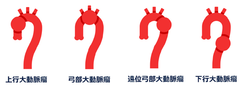 大動脈瘤と解離性大動脈瘤の違い心臓血管外科医 渡邊剛公式サイト
