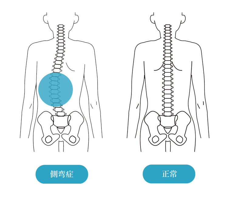 側弯症前橋市の整骨院なら前橋アイメディカル鍼灸整骨院