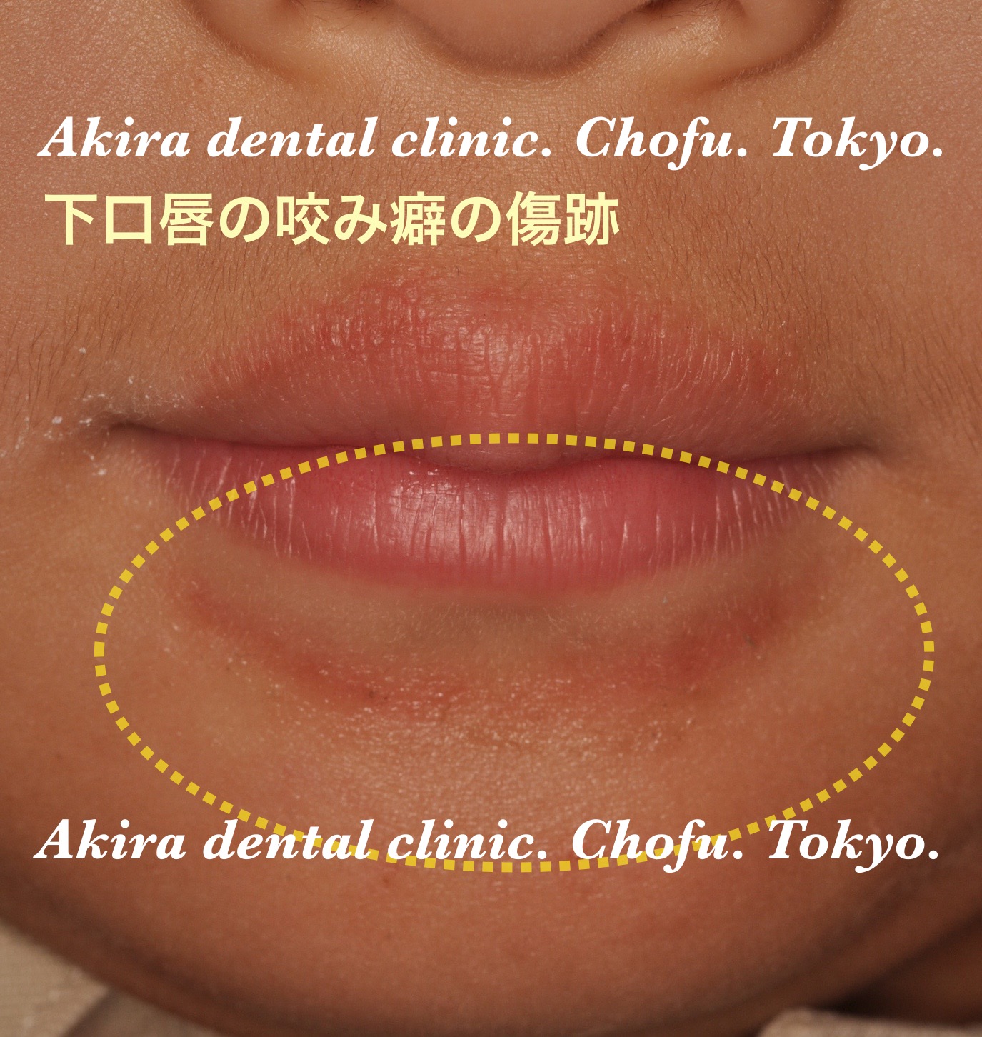 舌癖はどうして起こるの？舌癖があるとまずいの？たにもとゆうこ矯正歯科 岡山・玉野市