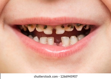 子供の虫歯治療- 奥歯- アズ歯科 桶川院