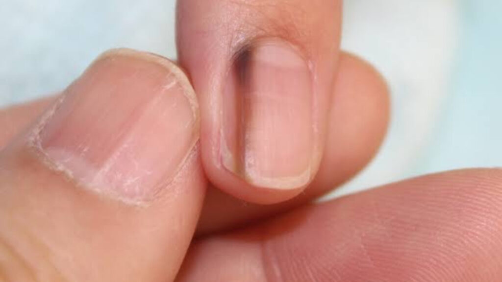 爪甲色素線条の鍼灸 原因・定義・症状- 銀座そうぜん鍼灸院 深層筋・自律神経 銀座・築地