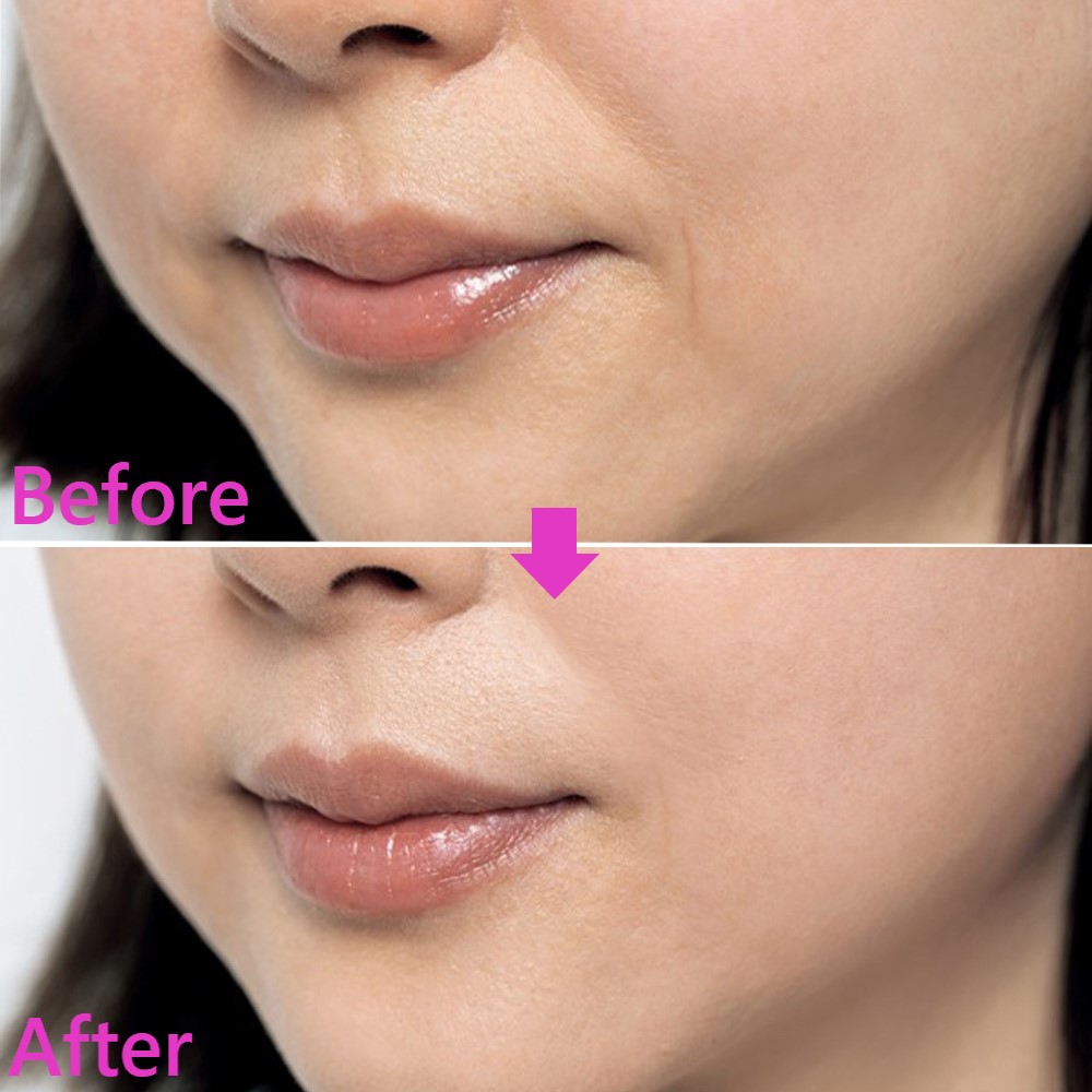 レチノールクリームはほうれい線の改善に効果的なの？エイジングケアを本気で学ぶ情報サイトナールスエイジングケアアカデミ