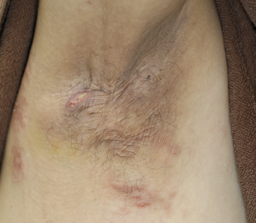 ワキガ・腋臭症渋谷スクランブル皮膚科