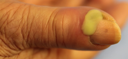 ひょう疽で膿んで痛い症状は何科に行けばよいか？放置は