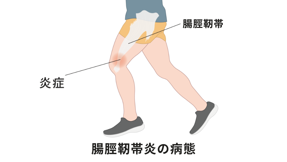 右太もも付け根の前側が力を入れると痛いんです北九州八幡西の整体 「からだ回復センター八幡西」