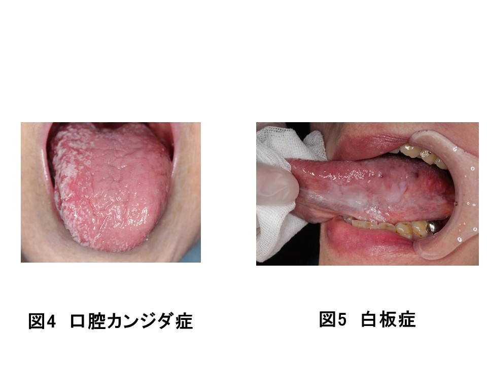 舌が痛い・舌痛症、症状と対策枚方くずはアップル歯科