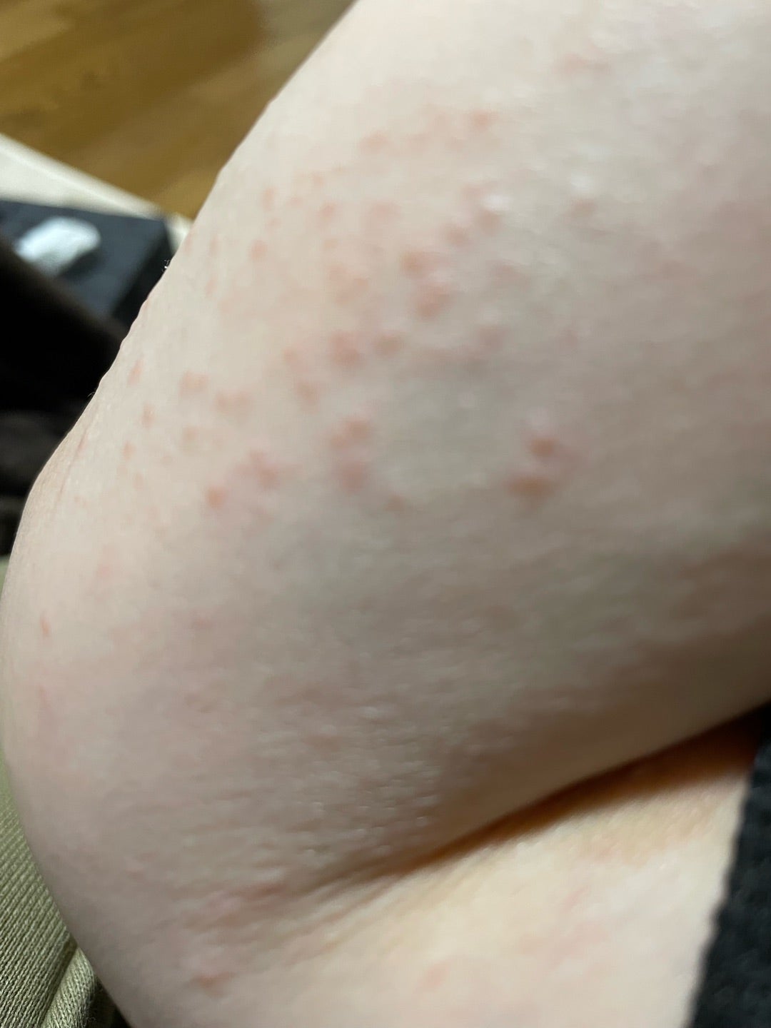 グロ注意 アルカのニューMVは、背中が大変！ 「ぶつぶつ恐怖症」の方はご用心！ - News - OTOTOY