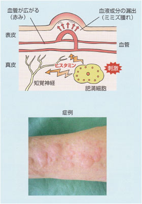 線状皮膚炎？：診断に苦労した 患者さま青山ヒフ科クリニック院長Dr.亀山のオフィシャルブログ