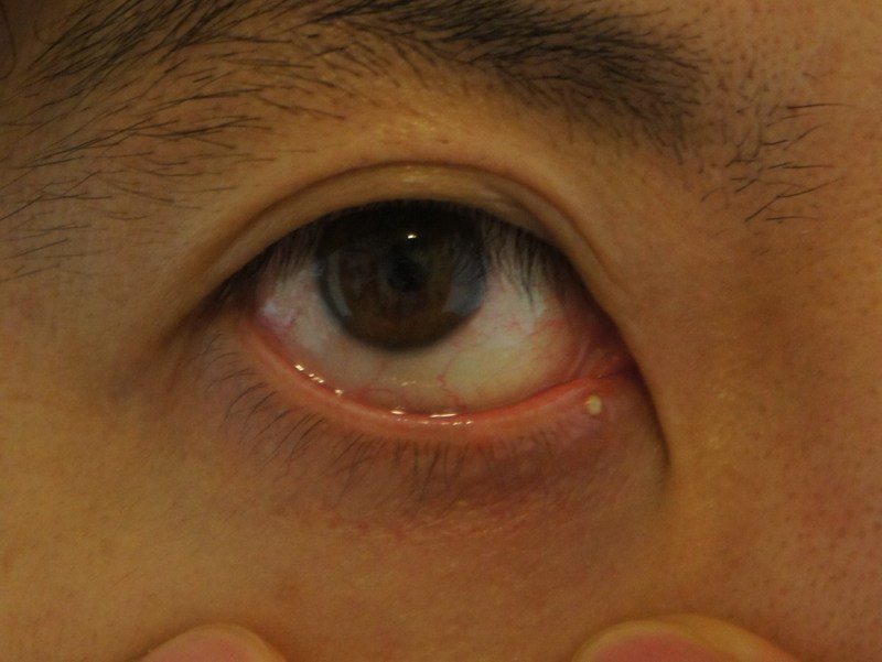 質問 撮影当日にものもらい、どうする？ぽんこつ母さん