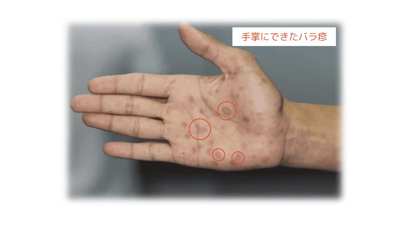 梅毒について - 原因・症状・検査・治療・予防- 横浜・渋谷・名古屋の性感染症内科ペアライフクリニック