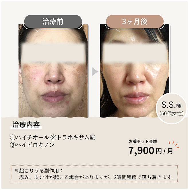 美容皮膚科「シミ」の症例写真聖心美容クリニック横浜院