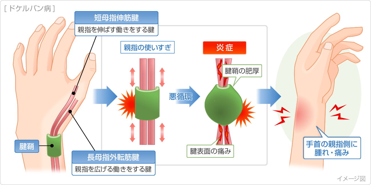 物を持ち上げると肘から前腕部にかけて痛む腕の重だるさ、肘痛のツボツボネット 鍼灸の症例が検索できるツボ辞典