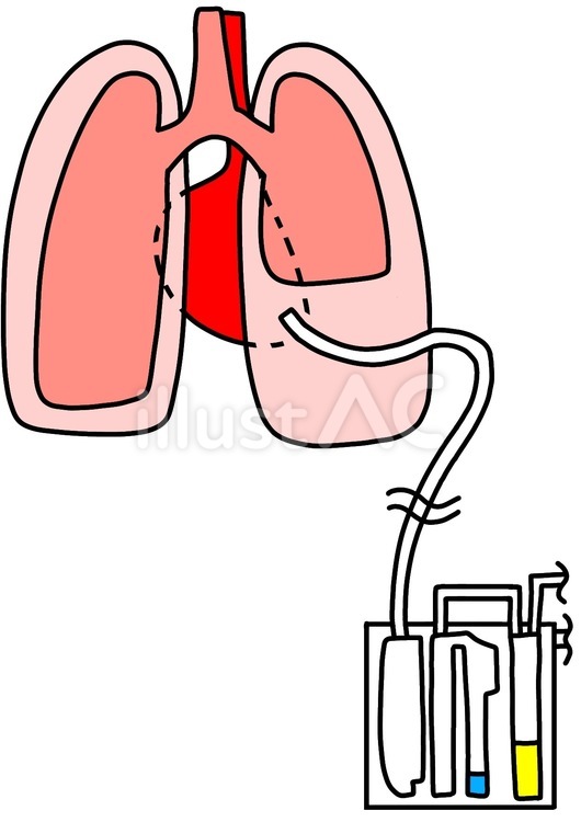 気胸での胸腔ドレナージの適応は？ 結論：中等度～重症コキュトレ