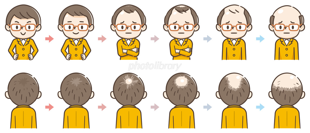 1,350 薄毛 High Res Illustrations - Getty Imagesハゲ, 薄毛 女性, 抜け毛