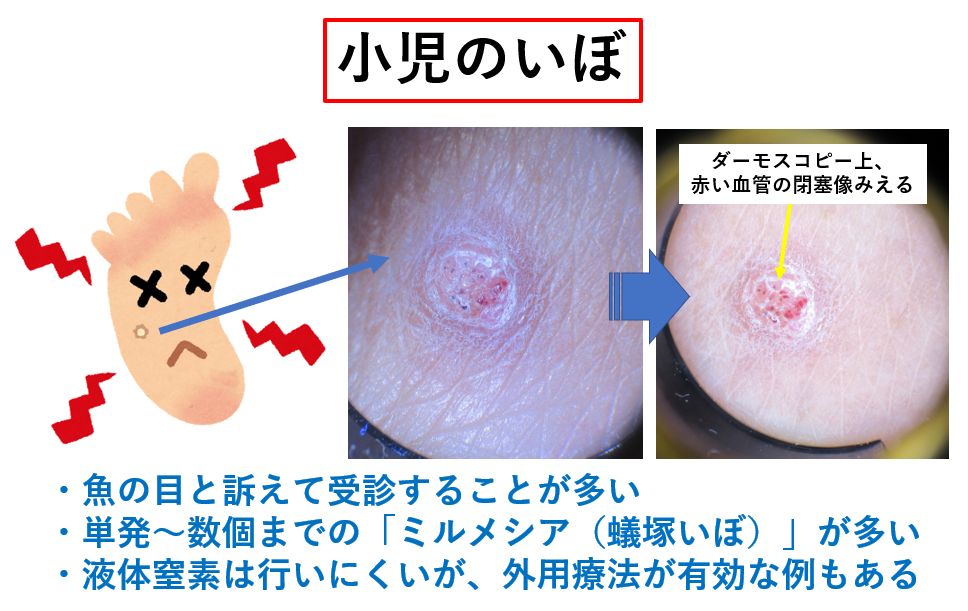 ウイルス性イボ目白通り皮フ科