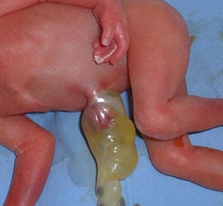 でべそ 臍ヘルニア池袋皮膚科形成外科。東口駅徒歩1分保険診療