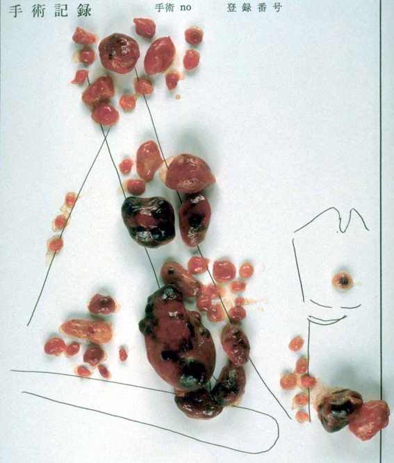流行性耳下腺炎りゅうこうせいじかせんえん とは済生会