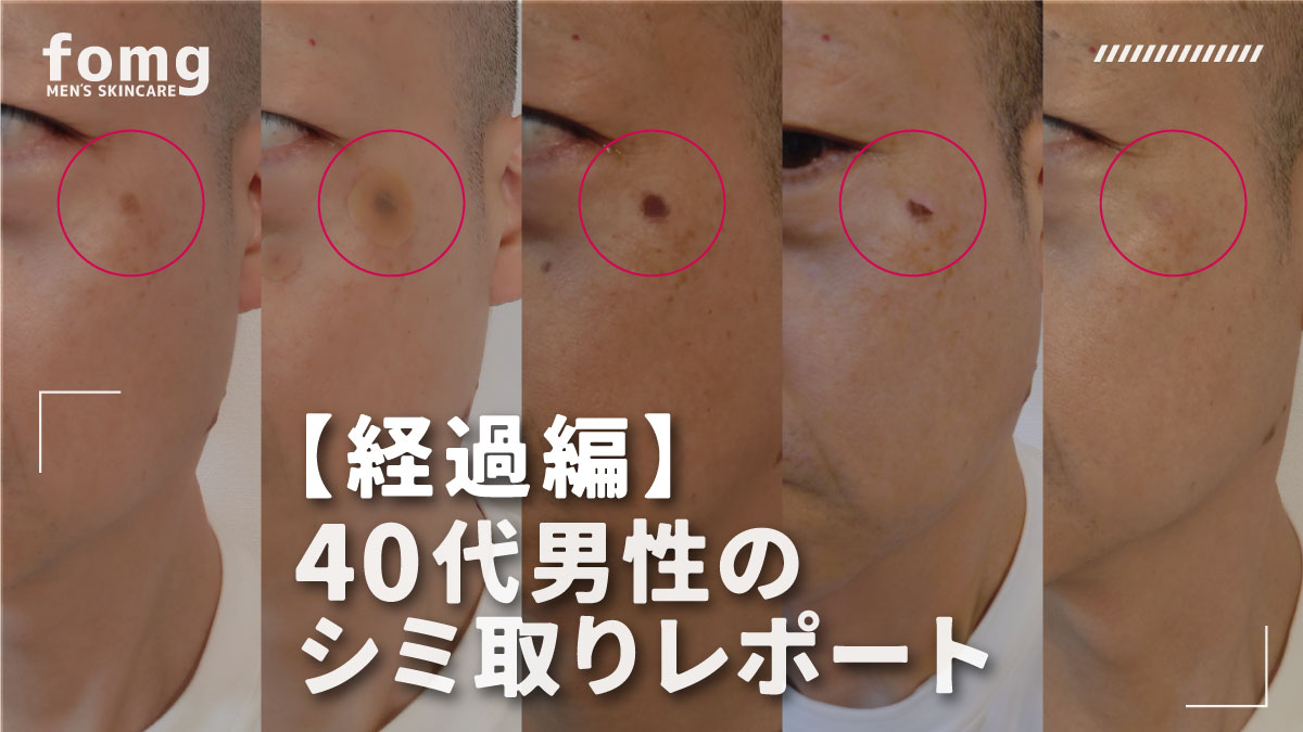 シミレーザー治療経過と処置 - 東京・大阪の美容皮膚科ならFLALU フラルクリニック