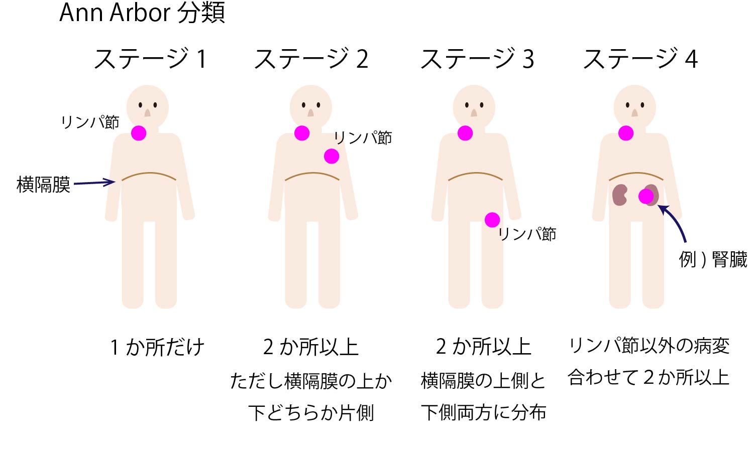 リンパ腫の症状 初期症状から進行時の全身症状までおしえて リンパ腫のコト 中外製薬