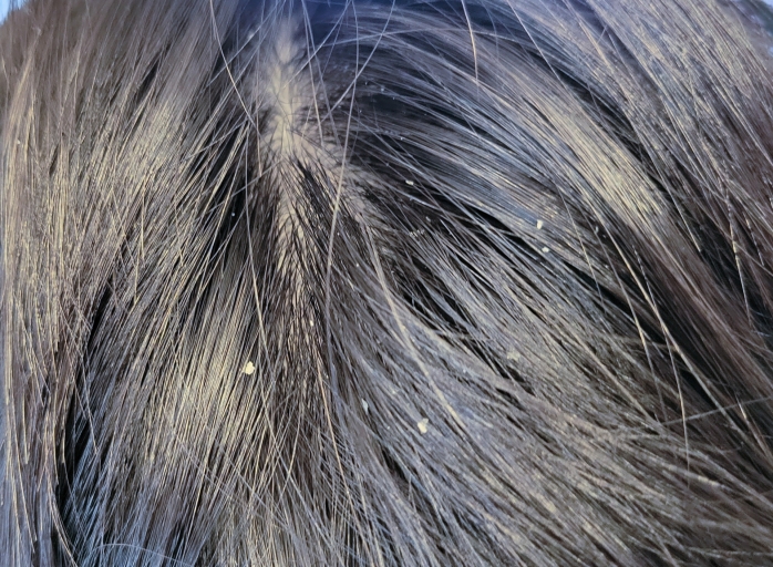 頭皮を押すと痛い」のは「帯状疱疹」が原因？医師が徹底解説！ - ライブドアニュース