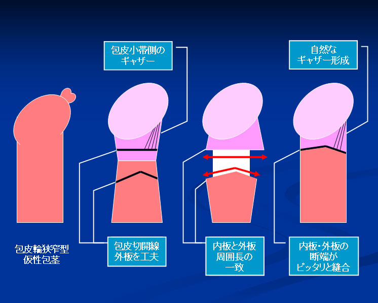 包茎 皮が余るについて | 医師に聞けるQ&Aサイト