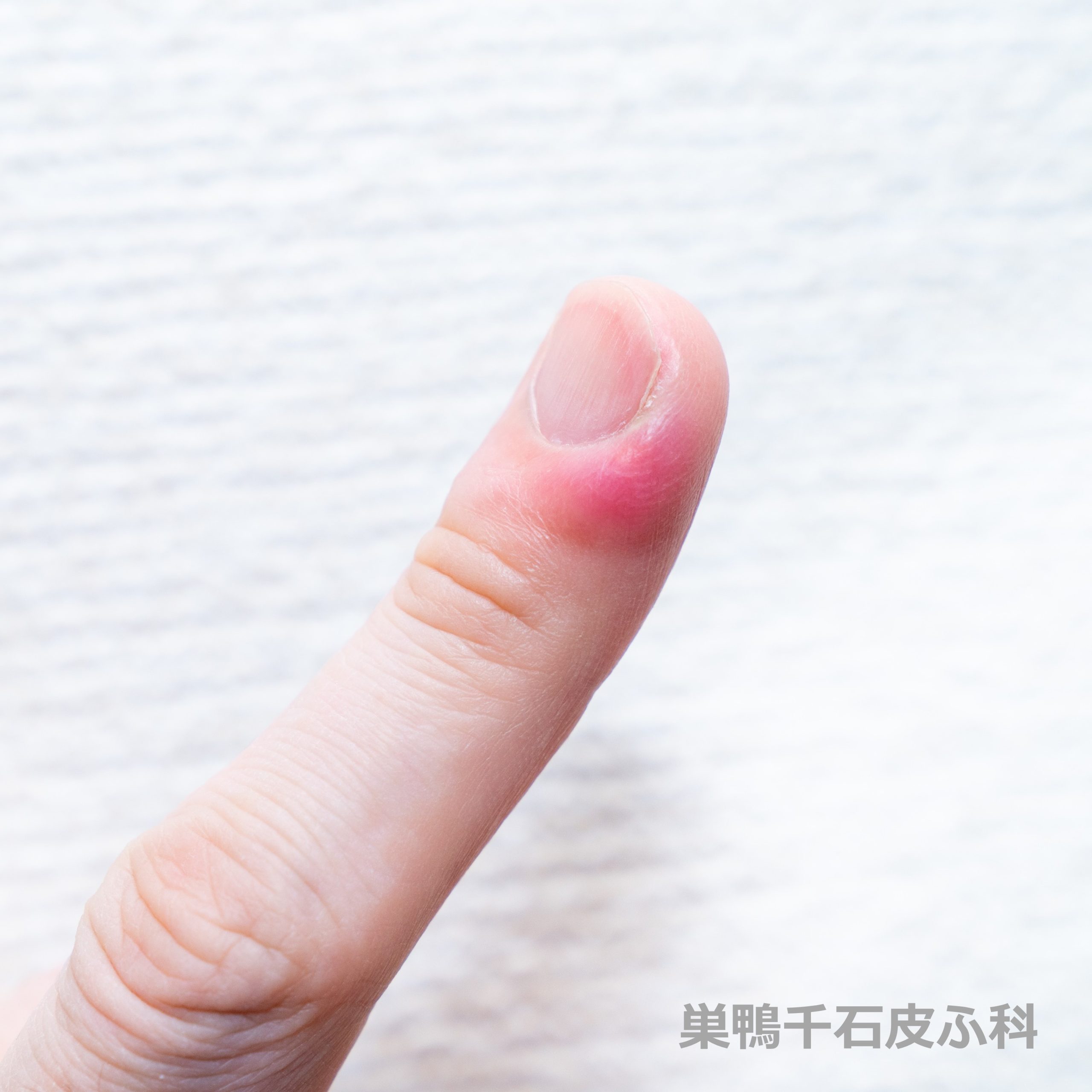 蜂窩織炎 急な腫れと熱があり、痛い！- 古東整形外科・リウマチ科