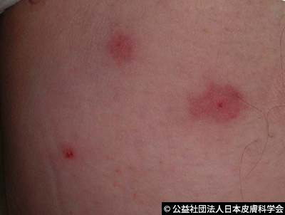 虫刺され町野皮ふ科坂戸市にっさい花みず木の皮膚科