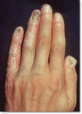 乾癬大田区大森・大木皮膚科 原因と治療薬・治し方を詳しく解説