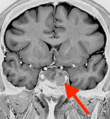 視野が半分欠けても気づけない！？失明の原因第1位の「緑内障」は早期発見が肝心 簡易チェックつきKindai Picks