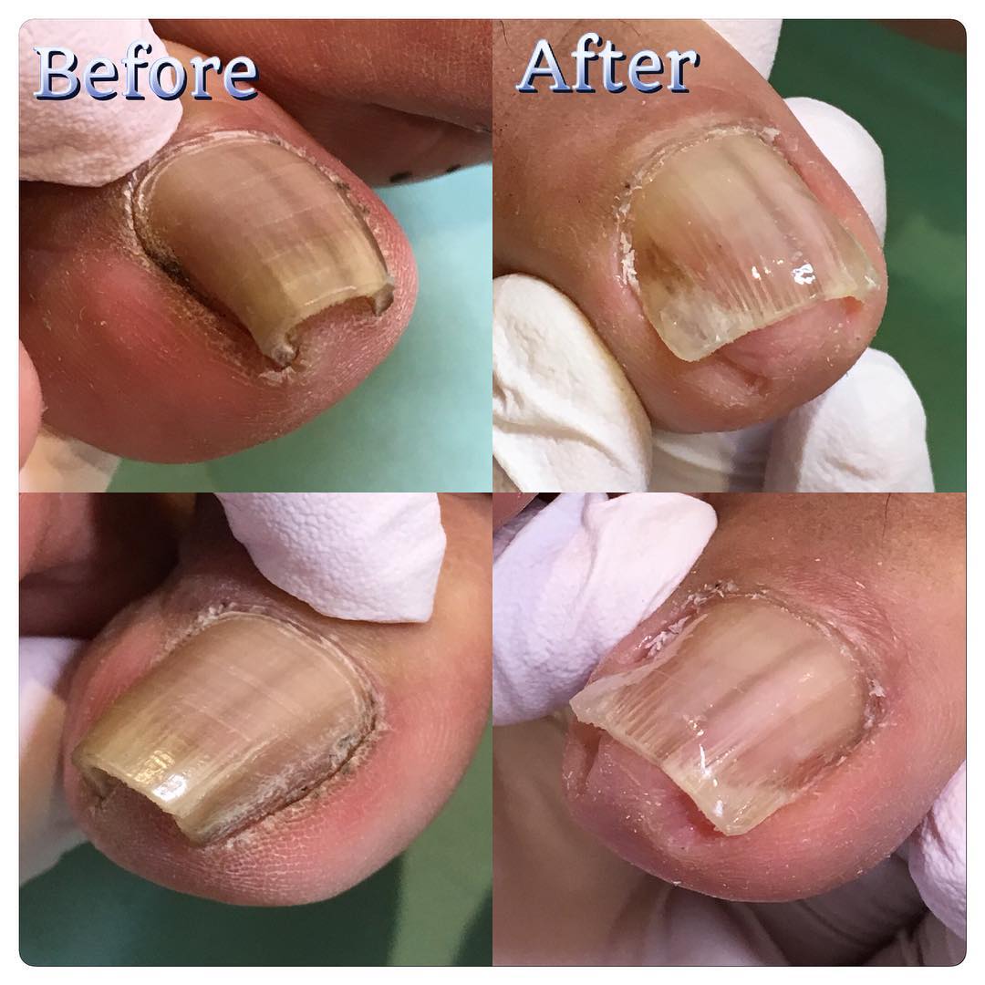 巻き爪 矯正 自分で 治療 爪切り 爪ワイヤー ネイルエイド １８ｍｍ セルフケア 病院 手術 治し方 : 巻き爪・陥入爪治療の相談室 - 通販 -Yahoo!ショッピング