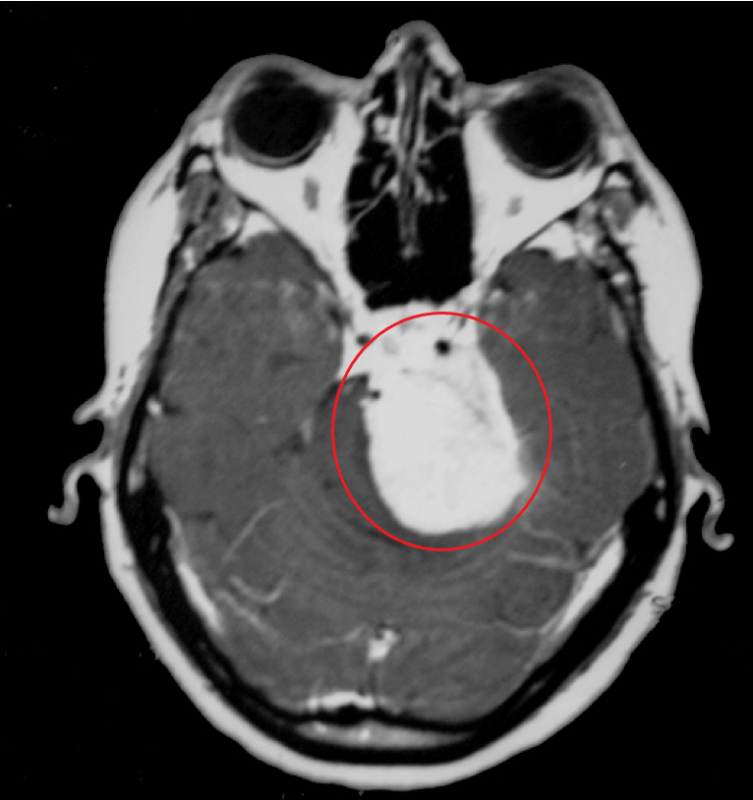 髄膜腫東京大学医科学研究所附属病院 脳腫瘍外科