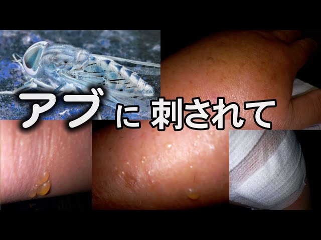 虫刺され対策 ブヨ ブユ の脅威!山梨県民がおすすめする登山・キャンプのお供 インセクト・ポイズン・リムーバーそらのしたスタイル