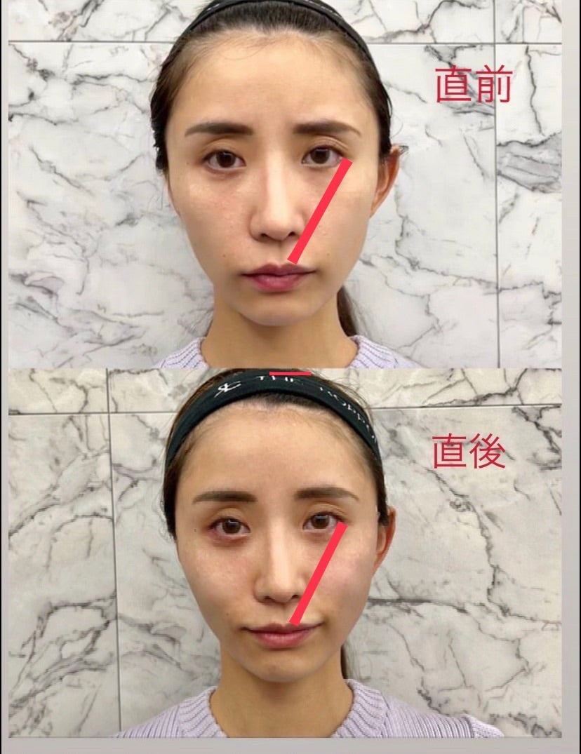 伊東美咲は鼻にプロテーゼを入れたのか？また鼻の穴の大きさの変化にも注目！芸能人のあれこれ特集