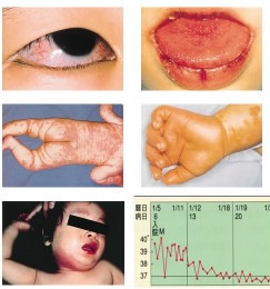 川崎病の冠動脈病変の発症に酸化リン脂質が関与する国立研究開発法人日本医療研究開発機構