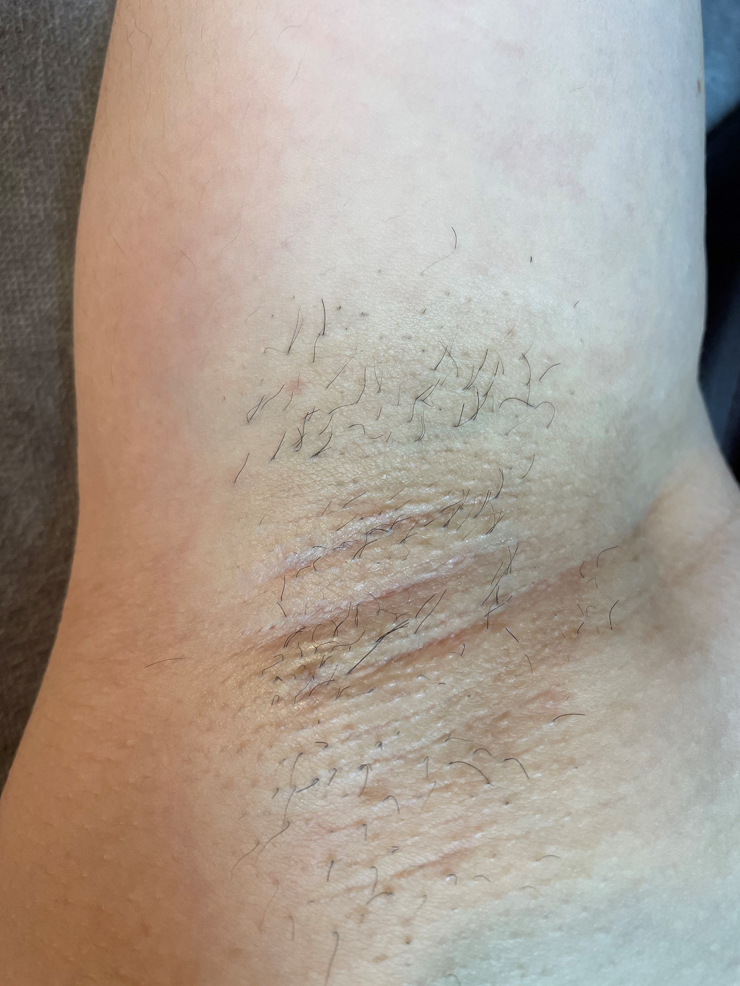 脱毛前のワキの写真・画像素材-Snapmart スナップマート