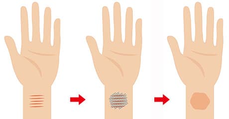 根性焼き・リストカット跡京都・滋賀の大西皮フ科形成外科医院 大津石山,四条烏丸
