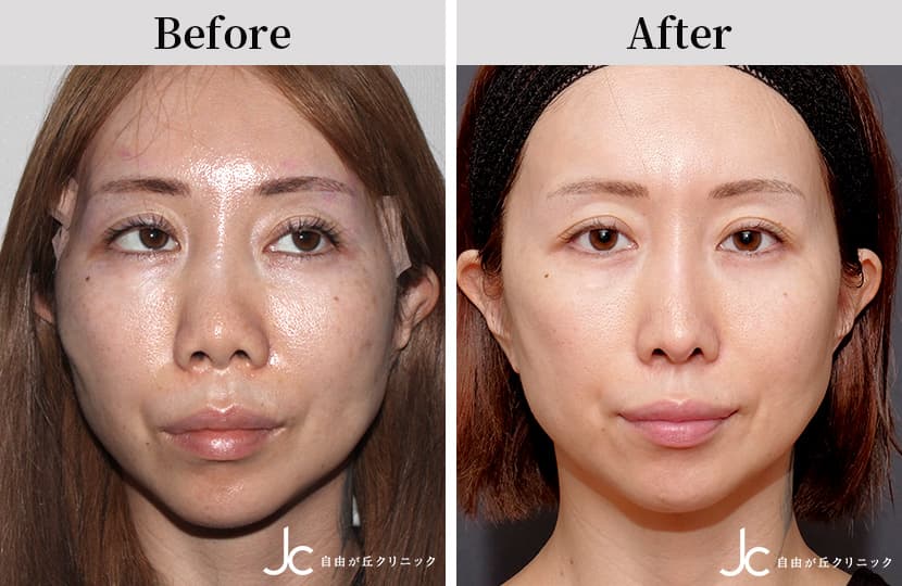 斜鼻矯正術 斜鼻修正鼻整形なら表参道スキンクリニック 公式