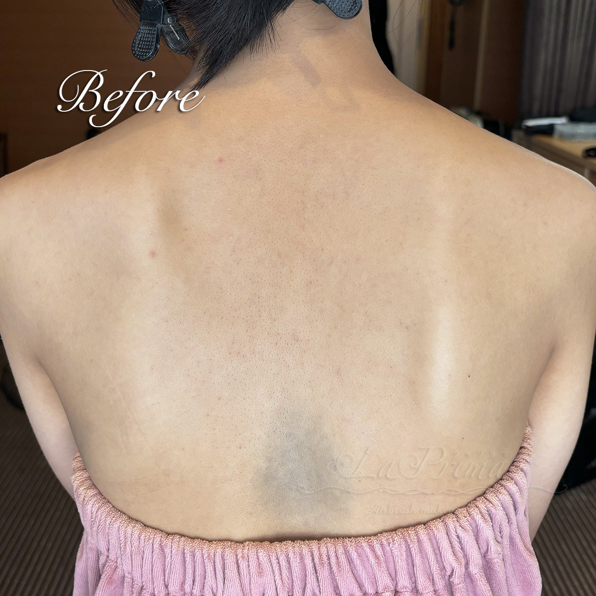 異所性蒙古斑 症例写真３ヶ月の男児 の説明スライド - 医療のイラスト・写真・動画、素材販売サイトのメディック medick